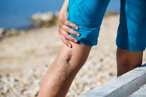 What Doctor Treats Varicose Veins.jpg