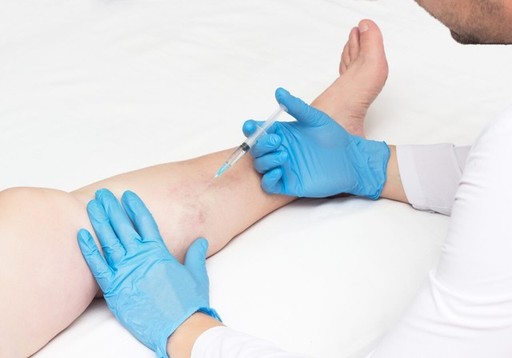 do spider veins come back after laser treatment.jp
