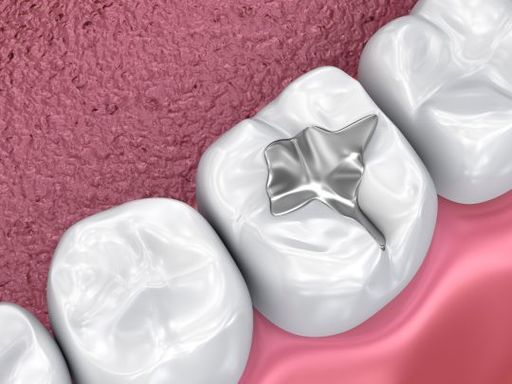 composite dental filling.jpg